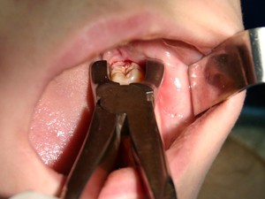 Как удалить нижний зуб мудрости