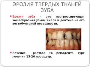 Признаки эрозии эмали зубов