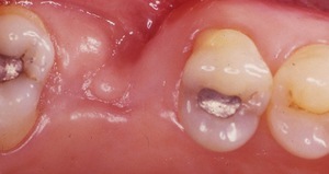 Абсцесс на месте удаленного зуба