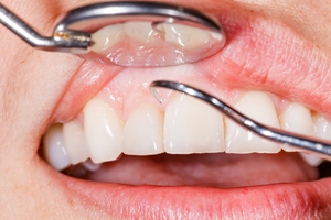 Как лечить воспаление корня зуба