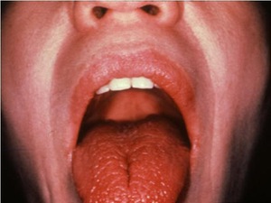 Ксеростомия-причина запаха изо рта