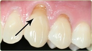Оголение основания зуба