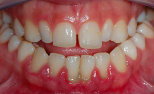 Описание заболевания дёсен и зубов пародонтита
