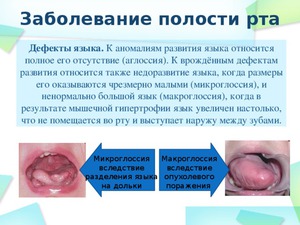 Вирусные заболевания полости рта