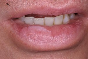 Лечение лейкоплакии полости рта и языка