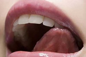 Формы лейкоплакии слизистой оболочки полости рта