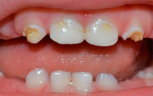 Почему крошатся зубы у детей