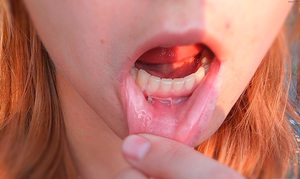 Как вылечить кисту на губе