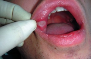 Описание патологии воспаление слизистой полости рта