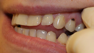 Описание заболевания пришеечного кариеса зубов