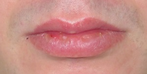 Лечение заболеваний губ