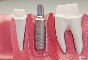 Импланты зубные
