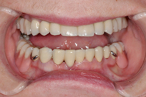 Особенности бюгельного протезирования зубов