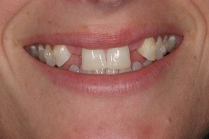 Показания для бюгельного протезирования зубов