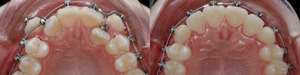 Какие есть виды выравнивания зубов
