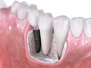 Импланты зубные