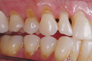 Последствия клиновидного дефекта зубов у пациентов