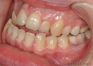 Мезиальный прикус — это патология в зубочелюстной системе