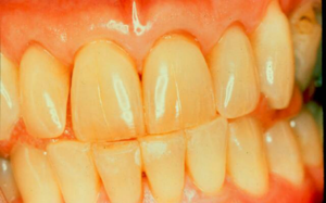 Если зубы пожелтели от курения или продуктов, можно вернуть им белизну