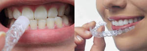 Отбеливающие средства для зубов
