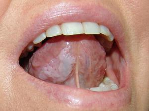 Что представляют собой белые болячки во рту