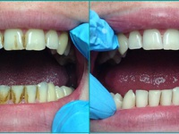 Метод удаления зубов от камня