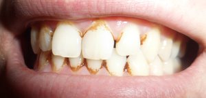 Зубной камень-как его вылечить