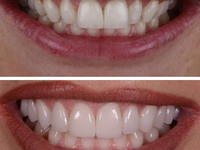 Накладки на зубы до и после