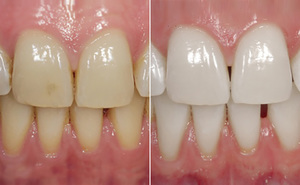 Почему стоматологи рекомендуют проведение фторирования зубов 