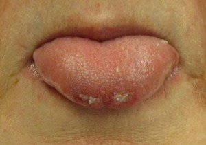Симптомы болезней языка