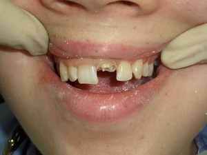 Особенности удаления корней зубов