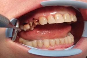 Способ выполнения ампутации корней зубов