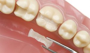 Особенности вкладок для зубов