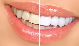Отбеливание зубов рекоммендации