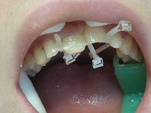 Способы выравнить зубы в домашних условиях