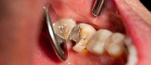 Зачем применяют мышьяк в стоматологии