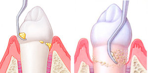 Причины появления зубных камней