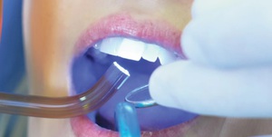Технология пломбирования зубов