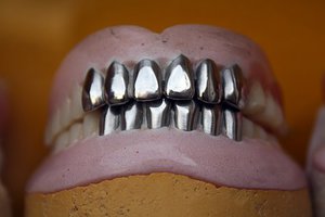 Металлические коронки для зубов