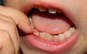 Что делать, чтоб быстрее выпали молочные зубы