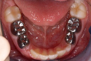 Разновидности коронок на зубы