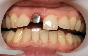 Описание способов установки и фиксации коронок на зубы
