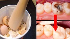 Как избавиться от кариеса без стоматолога