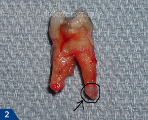 Удаленный зуб - последствия гранулемы