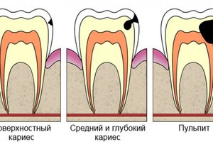 Почему появляется кариес на зубах