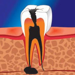 Как диагностировать кисту зуба