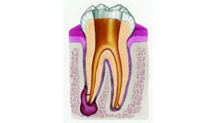Какими препаратами лечить кисту зуба