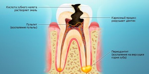 Почему появилась дырка в зубе