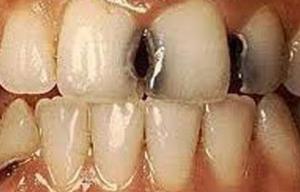 Причины появления дырки в зубах