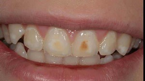 Некарионые поражения зубов до прорезывания